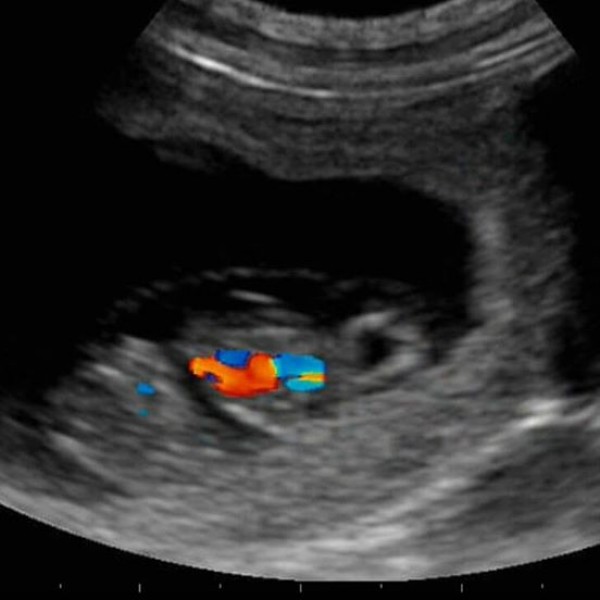 Mis niños los 3 Fs.. Ecografía embarazo