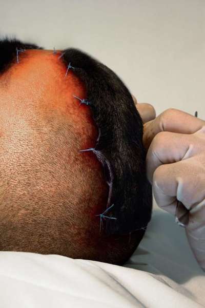 Poniéndole el implante en la cabeza